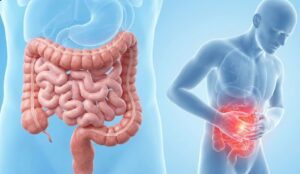 tratamiento enfermedades inflamatorias intestinales guadalajara